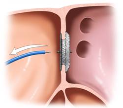 Принципы устранения дефекта