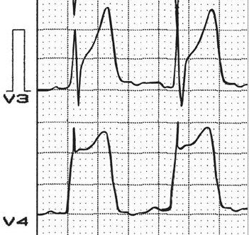 Признаки по исследованию ЭКГ