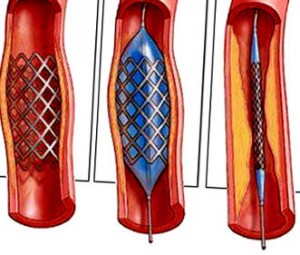 Шунтирование сосудов при отсутствии эффекта при консервативном лечении