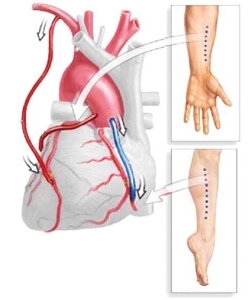 Шунтирование в Израиле