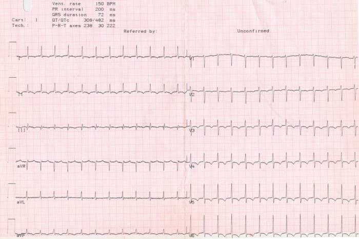 Суправентикулярная тахикардия признаки ЭКГ