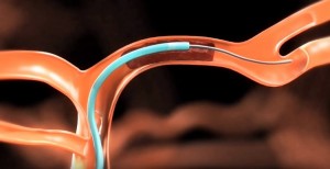 Тромбэктомия сосуда