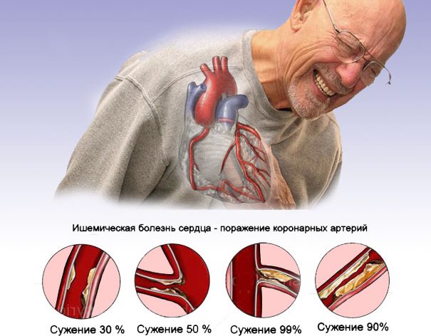 Лечебное питание при ишемической болезни сердца