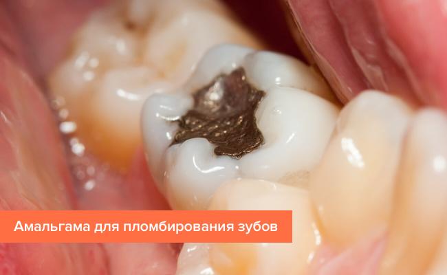 Зубные пломбы - лечение зубов