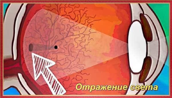 Деструкция и отслойка стекловидного тела