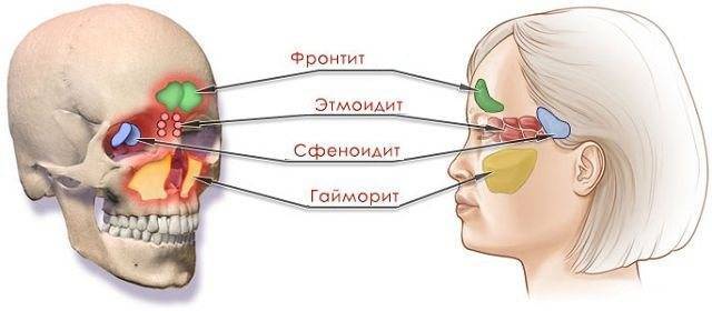 Сфеноидит у взрослых: что это за болезнь, признаки, симптомы, лечение, причины. как лечить сфеноидит