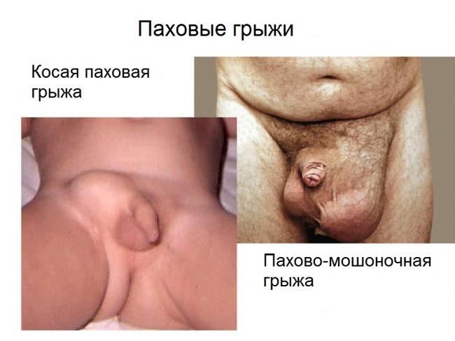 Паховая грыжа