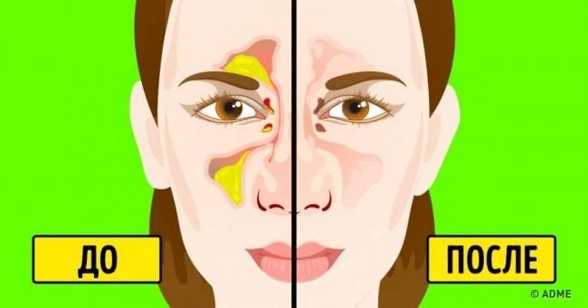При насморке заложило ухо: что делать в такой ситуации для лечения?