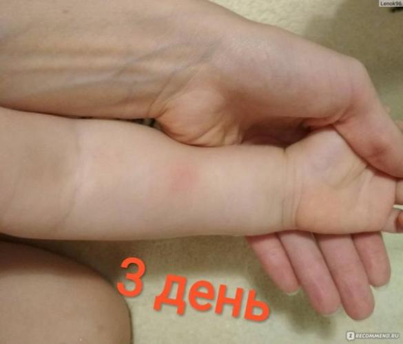 Нормы и отклонения при выполнении реакции манту взрослому человеку