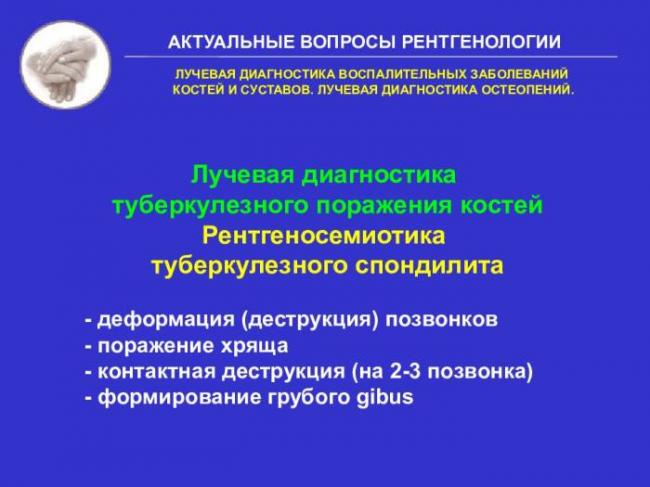 Туберкулезный спондилит: классификация, симптомы и лечение | все о суставах и связках