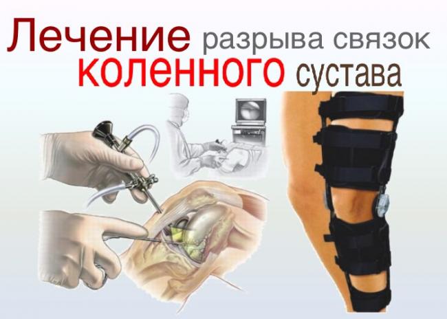 Растяжение связок коленного сустава