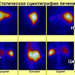 Что такое сцинтиграфия печени, что показывает анализ?