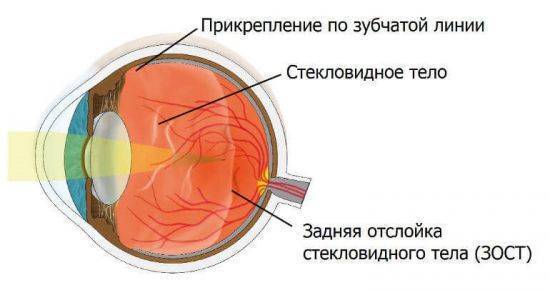 Деструкция и отслойка стекловидного тела