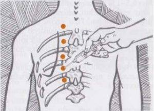 Блокада при грыже поясничного отдела позвоночника