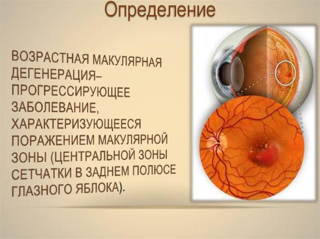 Центральная серозная хориоретинопатия: лечение, причины, симптомы, диагностика, прогноз, профилактика