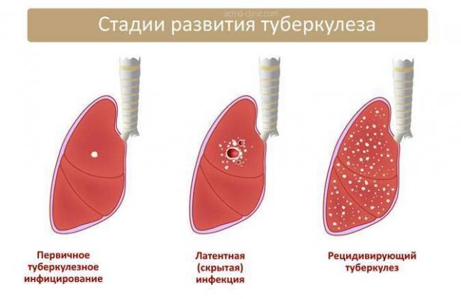 Туберкулез у взрослых: симптомы, первые признаки
22317
0