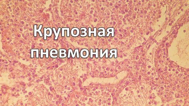 Описание крупозной пневмонии