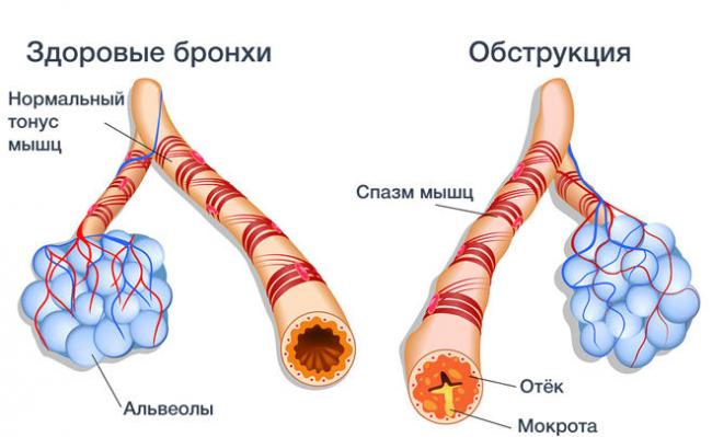 Лечение бронхита при беременности на начальных сроках