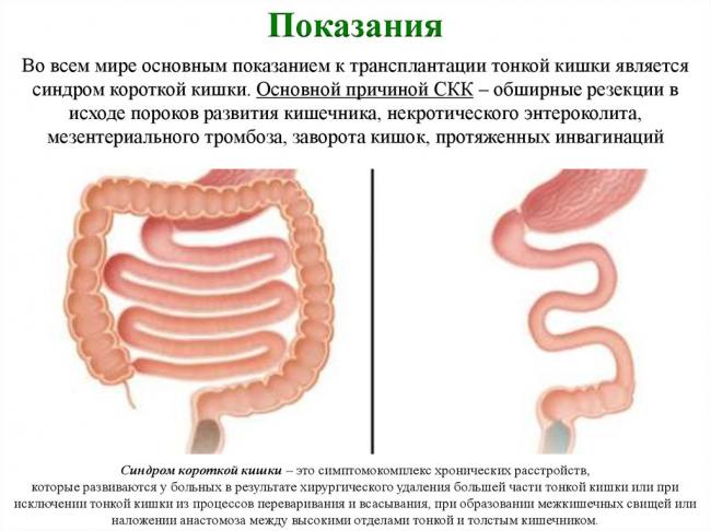 Кишечная непроходимость после операции в гинекологии