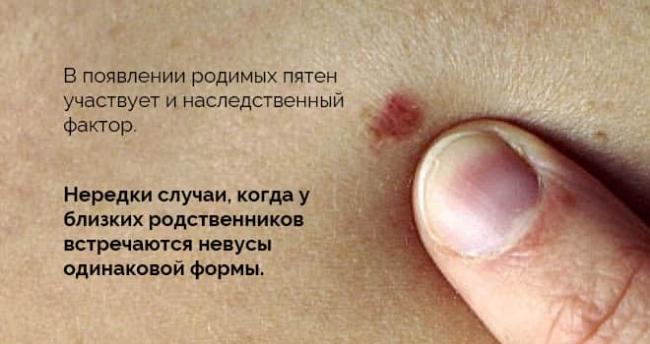 Бородавчатый невус фото