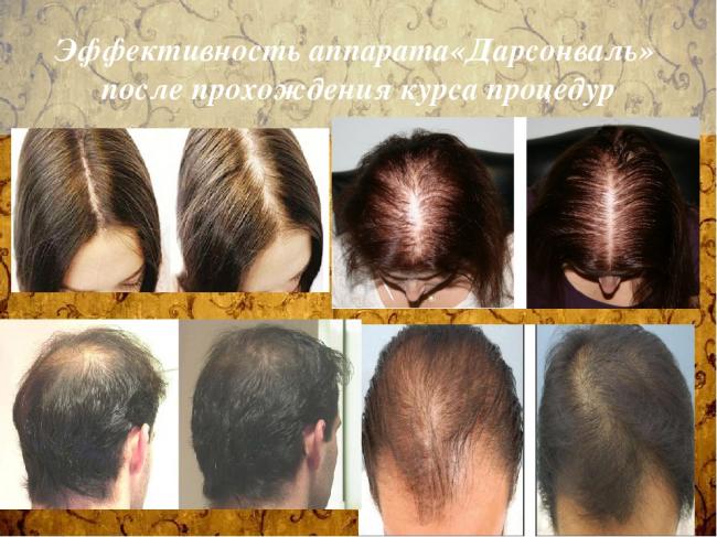 Дарсонваль (для лица, волос, головы): что это такое, отзывы