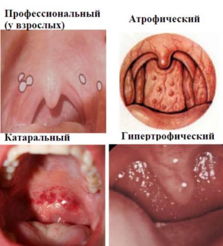 Ларинготрахеит у детей и взрослых: симптомы, лечение. чем лечить ларинготрахеит