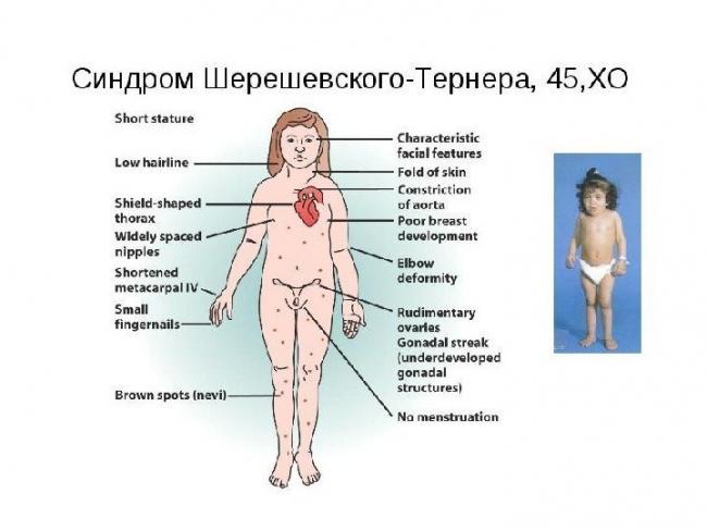 Что за странный диагноз — генитальный инфантилизм? недоразвитие половых органов (инфантилизм).