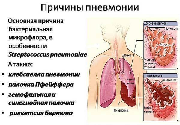 Медикаментозное лечение воспаления легких у детей по официальным рекомендациям и стандартам