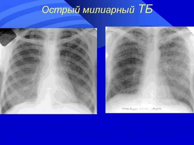 Туберкулез легких (милиарный): причины, признаки, профилактика — онлайн-диагностика