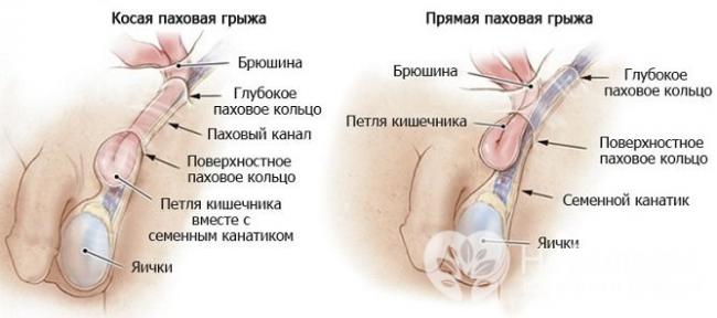 Паховая грыжа