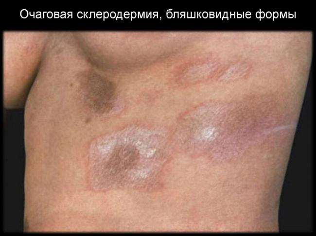 Склеродермия. признаки заболевания, фото, лечение, клинические рекомендации