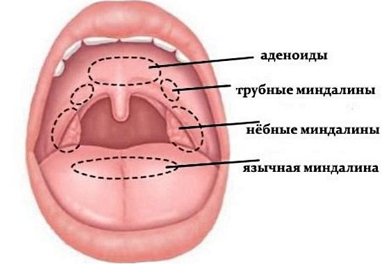 Острый тонзиллит (ангина)