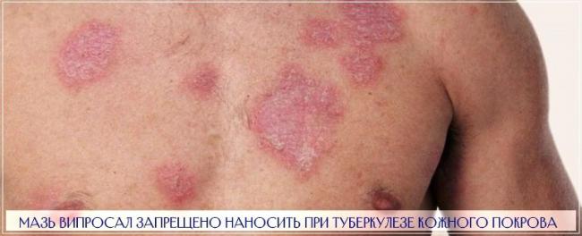 Болеутоляющая мазь «випросал» с ядом гадюки помогает при артрозах, остеохондрозах и невралгии