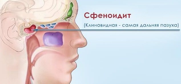 Катаральный синусит острый верхнечелюстной, фронтальный, катаральный этмоидит – симптомы, причины, лечение