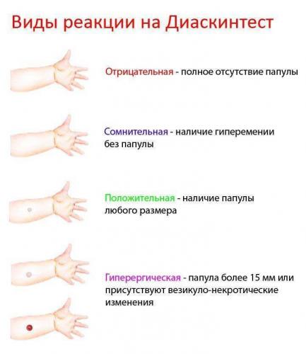 Сделали диаскинтест при простуде