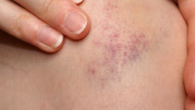 Кровоподтек — судебно-медицинская энциклопедия