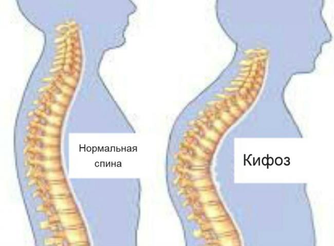 Лфк при кифозе грудного отдела позвоночника для детей