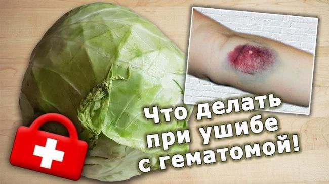 Гематома на ноге после ушиба