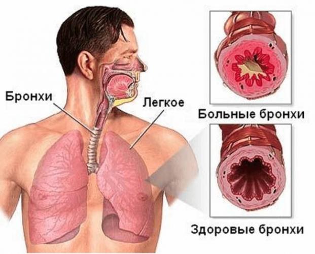 Можно ли ставить банки при лечении пневмонии?