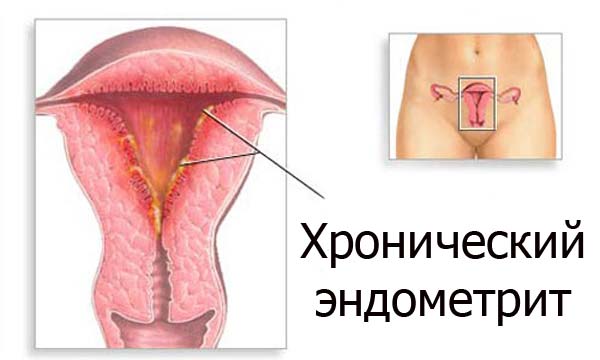 Эндометрит - симптомы и лечение
