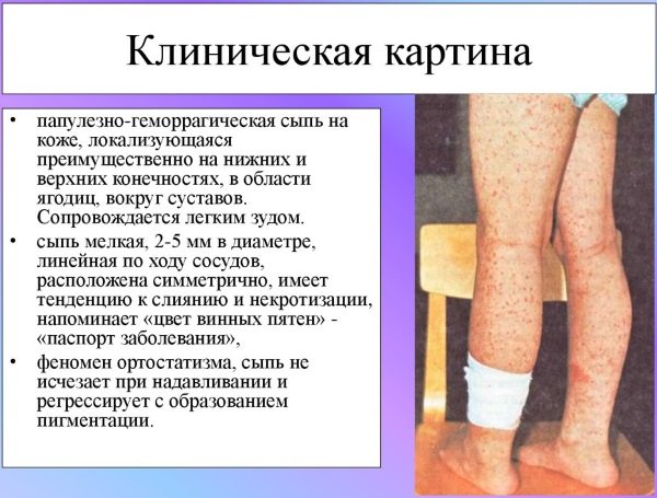 Ревматизм суставов — симптомы и лечение