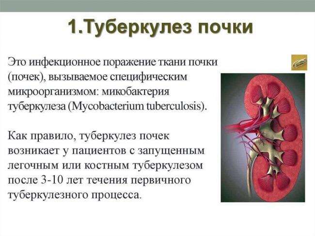 Первые признаки туберкулеза легких у женщин и мужчин