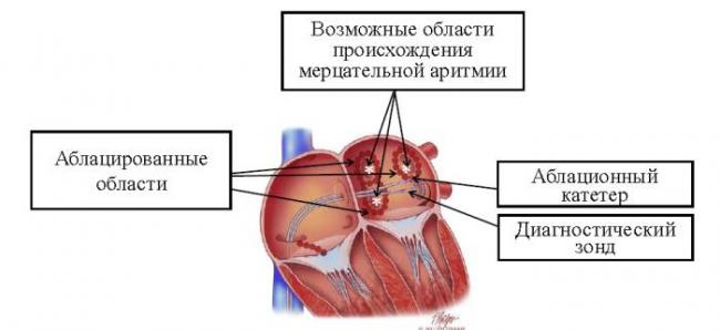 Мерцательная аритмия сердца: описание, причины, симптомы, опасность и лечение