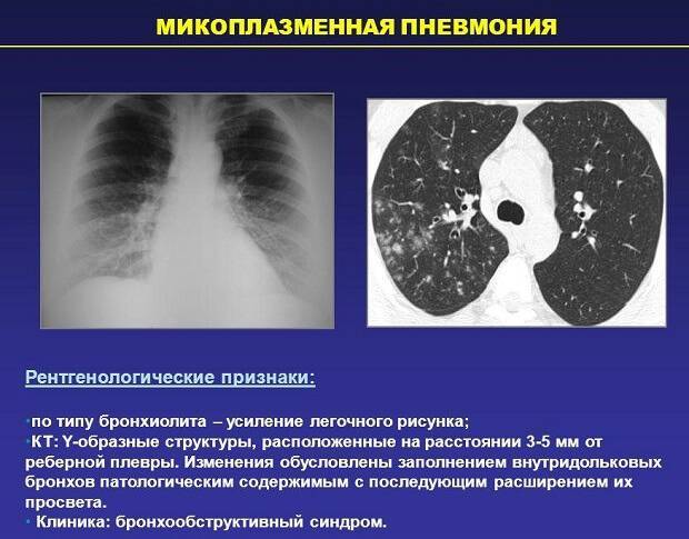 Причины микоплазменной пневмонии, характерные симптомы и принципы лечения