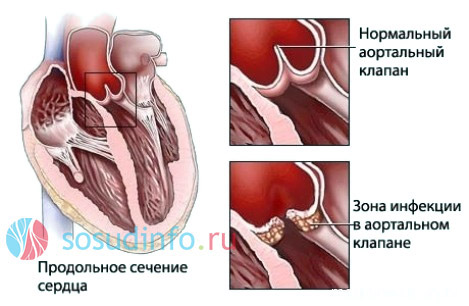 Ревматическая лихорадка. причины, симптомы, признаки, диагностика и лечение патологии