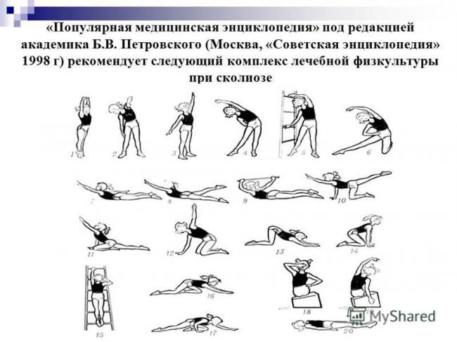 Кифосколиоз грудного отдела позвоночника