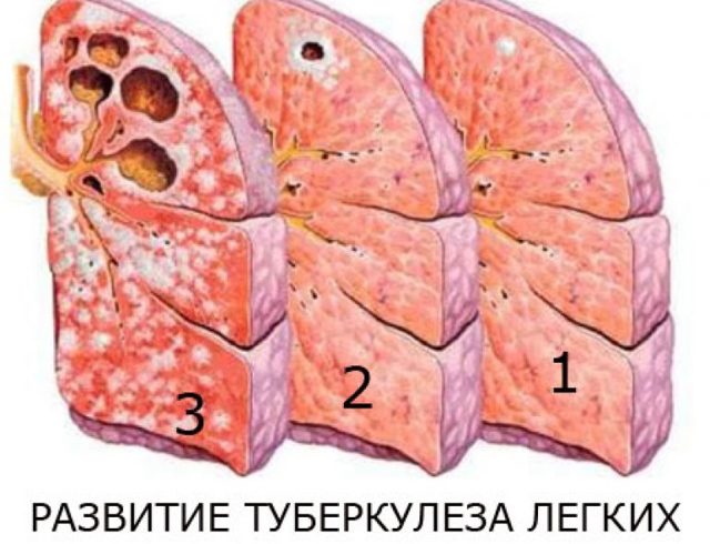 Народное средство от туберкулеза позвоночника. туберкулез легких. народное лечение туберкулеза легких. болезни бронхов и легких.
