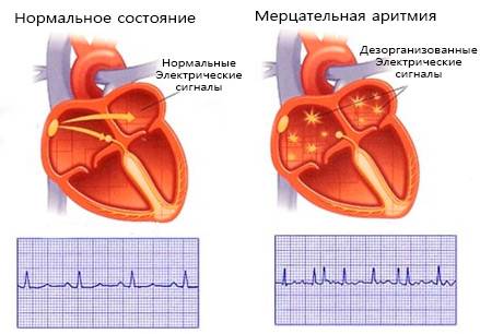 Причины, симптомы и лечение аритмии
