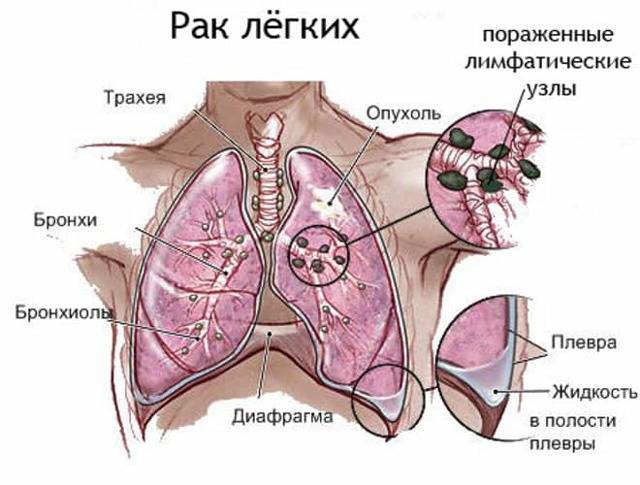 Первые симптомы туберкулеза