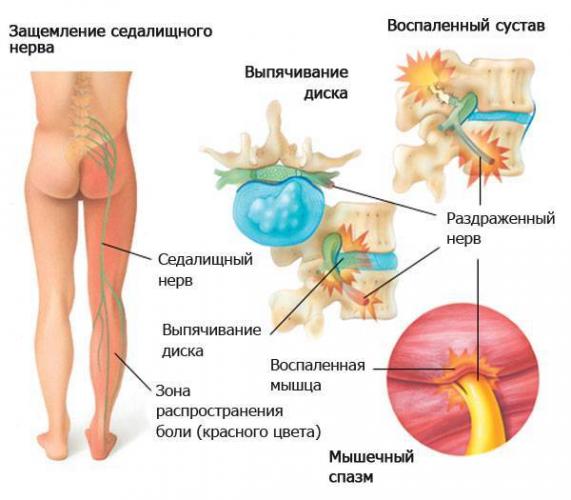 Блокада при грыже поясничного отдела позвоночника